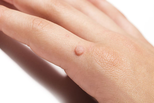 wart on a finger