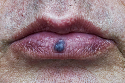 venous lake on bottom lip