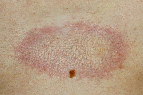 Morphea (Localized Scleroderma)