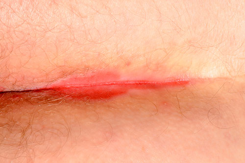 Candidiasis of the Skin