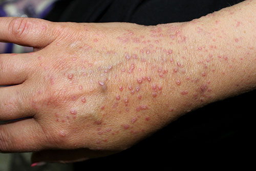 A case of lichen planus in a woman.