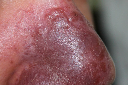 A case of cutaneous sarcoidosis in a young man