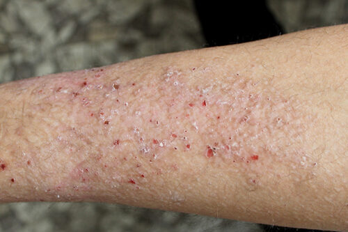 A case of lichen simplex chronicus