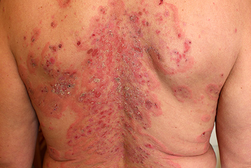 A case of pemphigus foliaceus in a female.