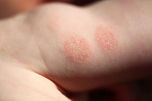 Atopic dermatitis child
