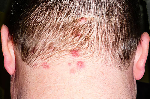 Dermatitis Herpetiformis