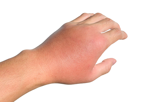 Inflammation, swelling, redness of the hand