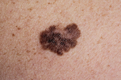 melanoma - a malignant tumor of the skin