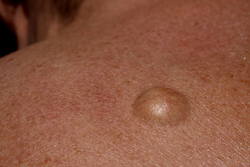 Sebaceous cyst" on his back