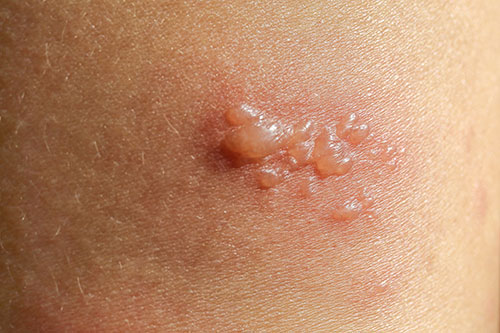 Bullous pemphigoid