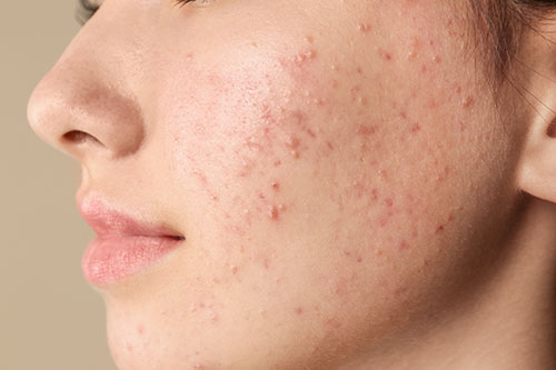 Teenage girl with acne problem