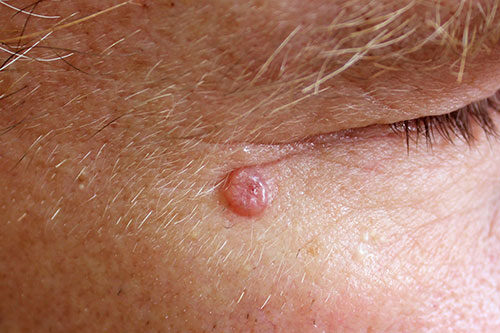 A case of nodular basal cell carcinoma