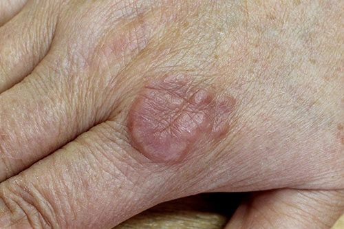 A case of granuloma annulare in a female