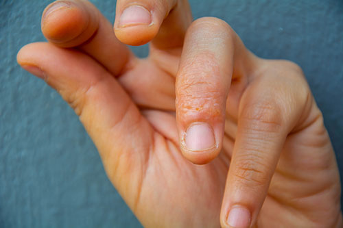 Close-up Dyshidrotic eczema,