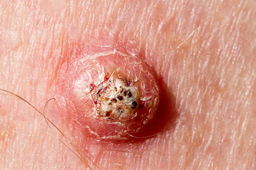 Keratoacanthoma on the leg of a 64 year old