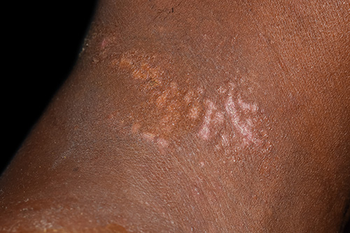 Pitriasis Alba on neck