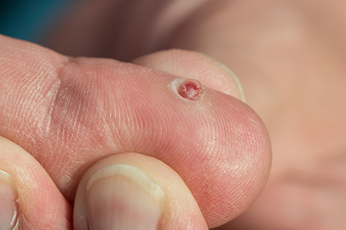 Pyogenic granuloma bloody wound on a finger