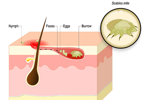 Scabies graphic