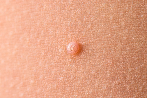 Detail of a molluscum contagiosum nodule