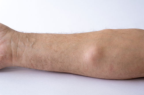 Lipoma on forearm