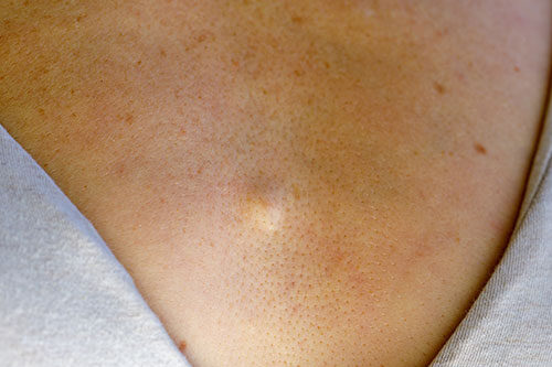 ebacous hyperplasia of the woman's chest