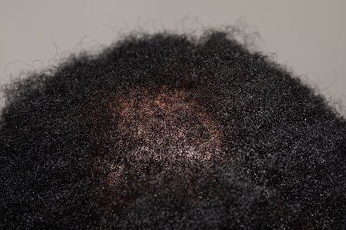 losing hair on scalp