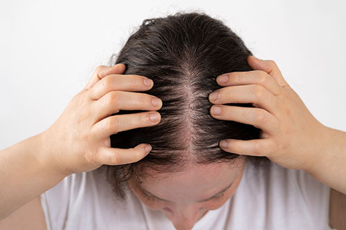 Female Pattern Hair Loss (Androgenetic Alopecia)