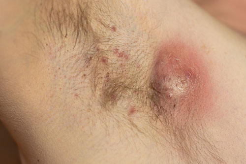 Hidradenitis Suppurativa