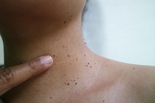 Close up the skin tags on woman's neck