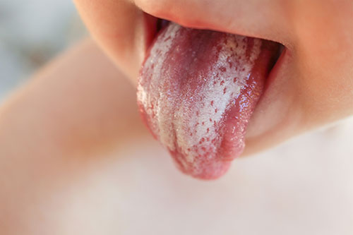 White coating on tongue