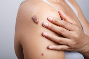 Skin Color Growth Skin Growths | Types, Symptoms & Evaluation
