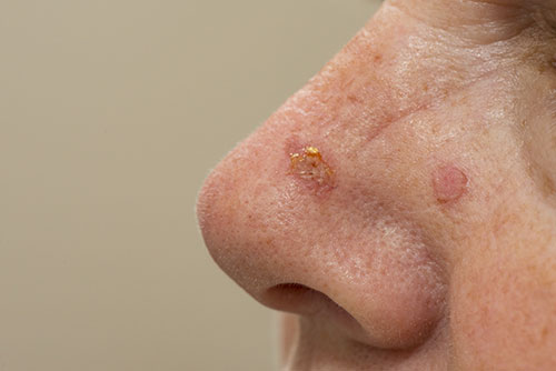 actinic Keratosis on nose