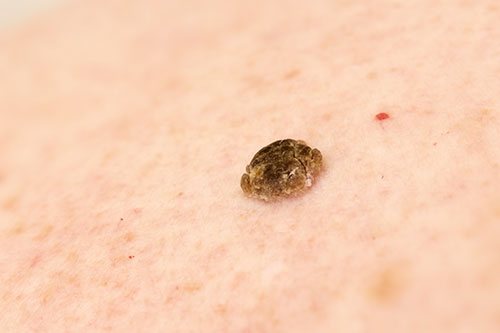 Seborrheic keratosis