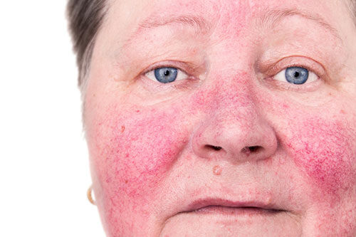 An elderly woman with skin rosacea condition