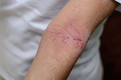 Dermatitis on the arm