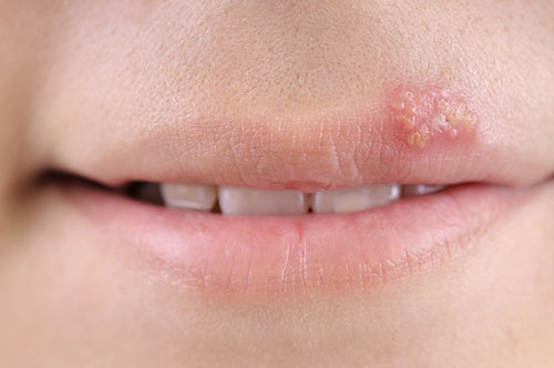 lesion on upper lip