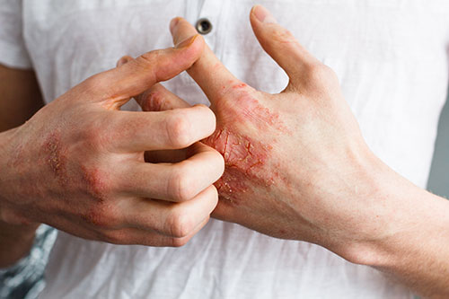 eczema on hand