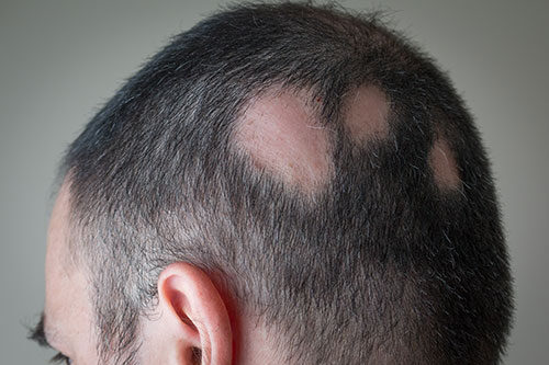 Alopecia Aerata - Spot Baldness
