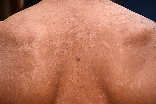 tinea on back