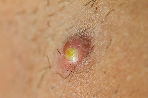 Pimple Extreme Macro with growing hairs