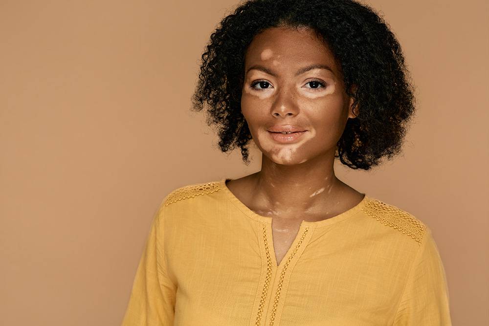 Woman with vitiligo